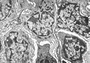 M,73y. | spleen - hairy cell leukemia M,73y. | spleen - hairy cell leukemia